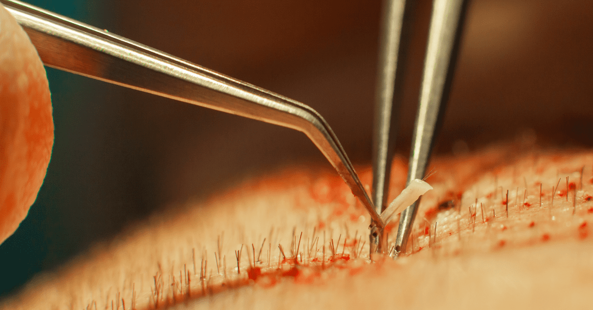 Hair Transplant Cost in Dehradun: A Complete Guide by Alloroots - Alloroots Hair Transplant Clinic - India's Best Hair Transplant Services