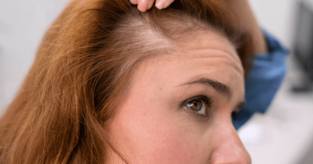 Hair Loss: Telogen Effluvium vs Androgenetic Alopecia 11 Hair Loss: Telogen Effluvium vs Androgenetic Alopecia - Alloroots Hair Transplant Clinic - India's Best Hair Transplant Services