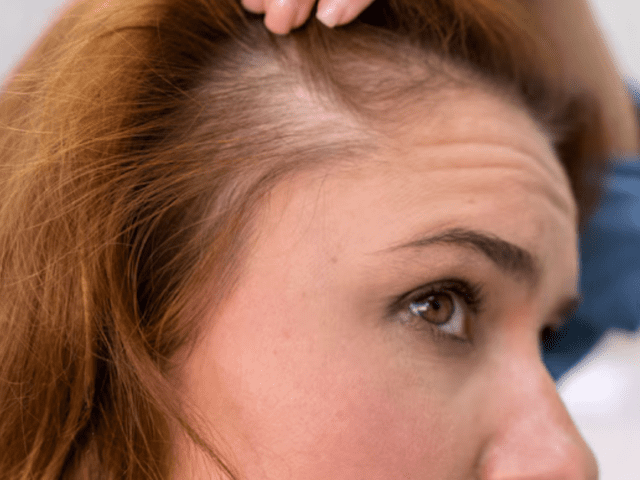 Hair Loss: Telogen Effluvium vs Androgenetic Alopecia