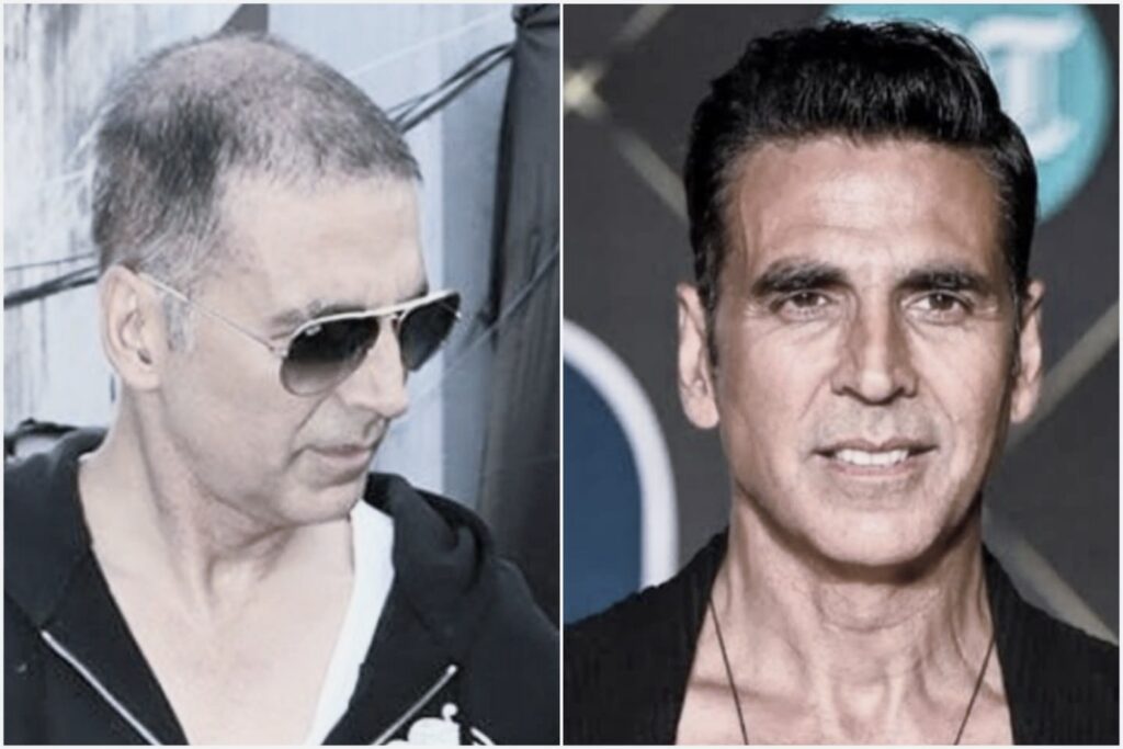 Bollywood Celebrity Hair Transplant Analysis - Alloroots Hair Transplant Clinic - India's Best Hair Transplant Services