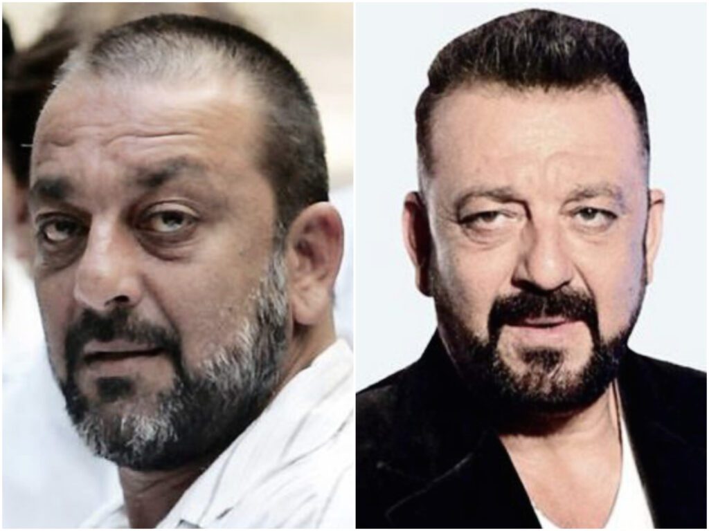 Bollywood Celebrity Hair Transplant Analysis - Alloroots Hair Transplant Clinic - India's Best Hair Transplant Services