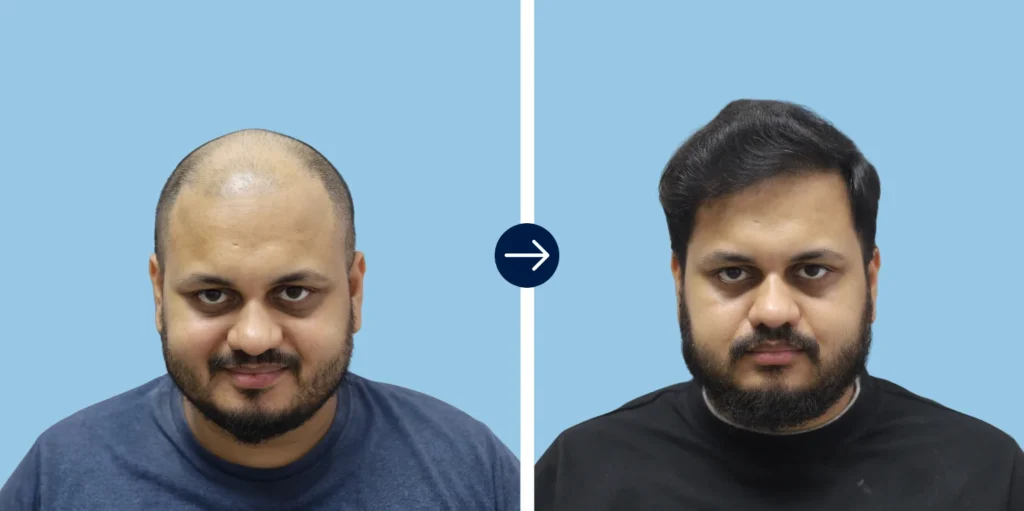 Results - Alloroots Hair Transplant Clinic - India's Best Hair Transplant Services
