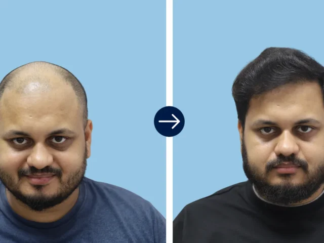 Why Indian Expats in Dubai Travel Back Home for Hair Transplants