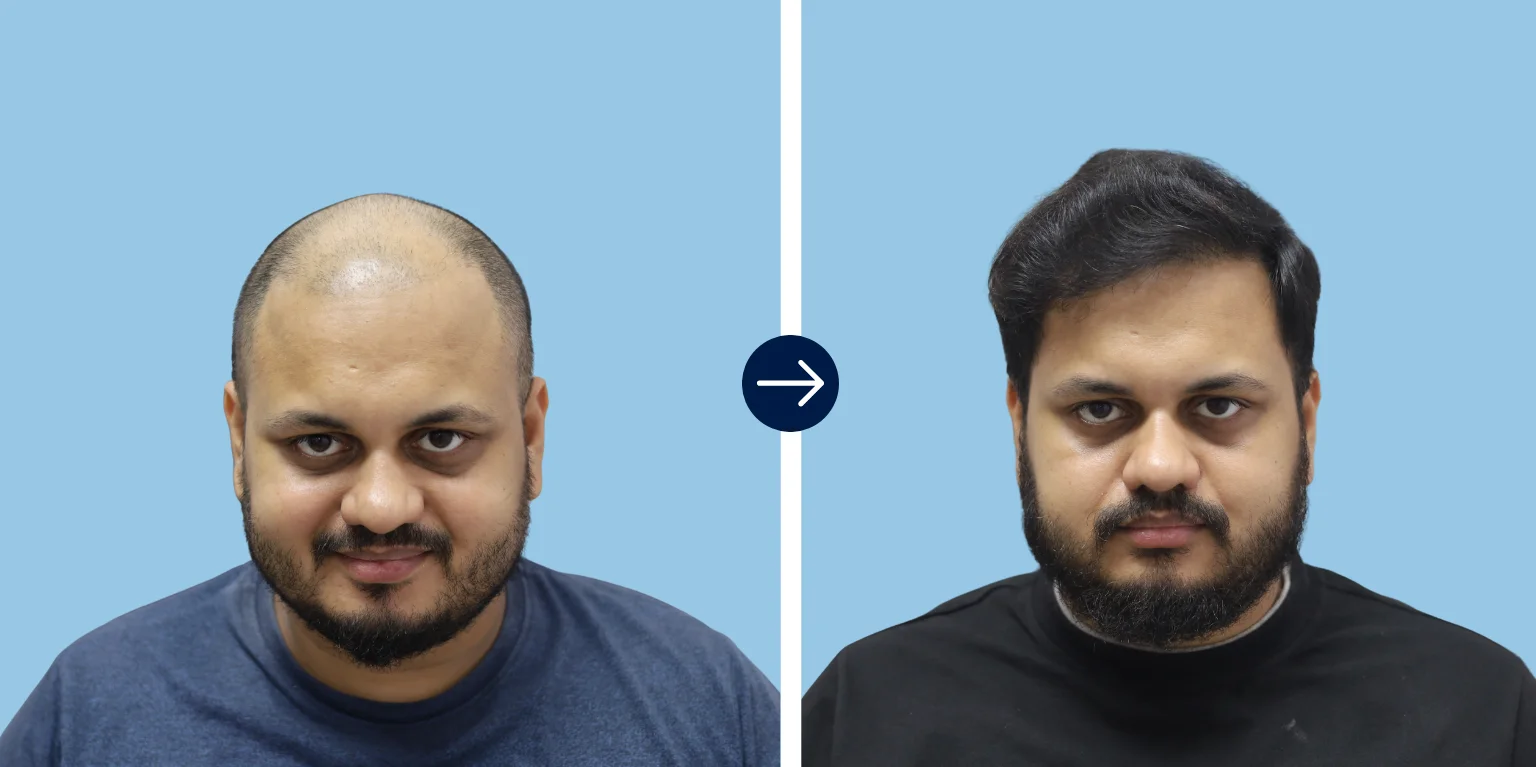 Results - Alloroots Hair Transplant Clinic - India's Best Hair Transplant Services