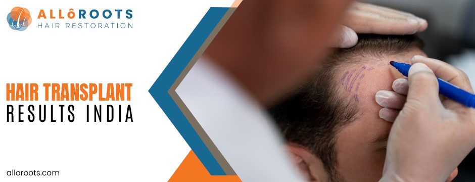 Top Hair Transplant Methods in India: Techniques, Results, and Treatment Cost Explained 1 Top Hair Transplant Methods in India: Techniques, Results, and Treatment Cost Explained - Alloroots Hair Transplant Clinic - India's Best Hair Transplant Services
