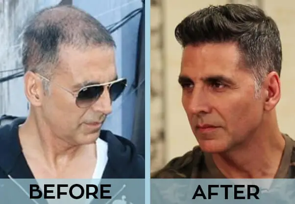 Bollywood Celebrity Hair Transplant Analysis 4 Hollywood Celebrity Hair Transplant Analysis - Alloroots Hair Transplant Clinic - India's Best Hair Transplant Services