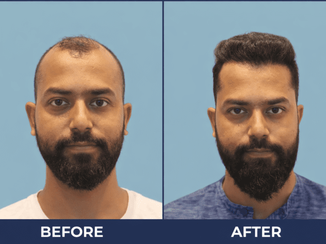 Best Hair transplant in India (2026)