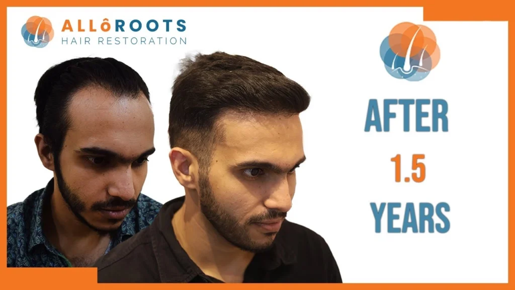 Hair Transplant in Bhubaneswar Performed By Experts - Alloroots Hair Transplant Clinic - India's Best Hair Transplant Services