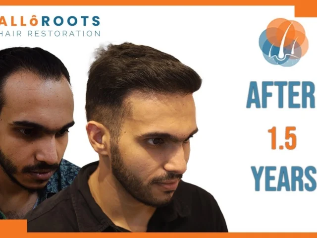 Who Is a Good Hair Transplant Candidate in 2026?