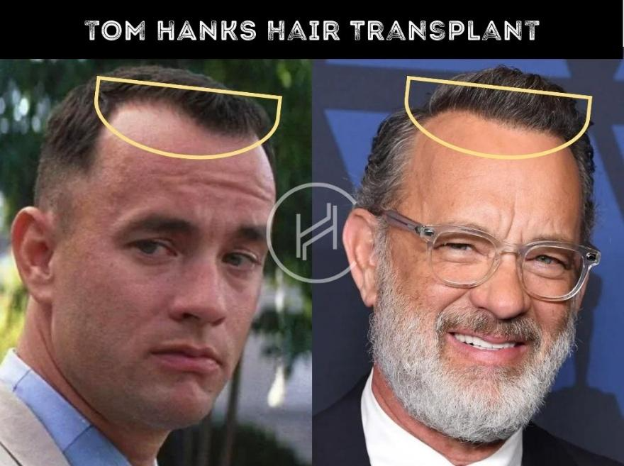 Hollywood Celebrity Hair Transplant Analysis 4 Hollywood Celebrity Hair Transplant Analysis - Alloroots Hair Transplant Clinic - India's Best Hair Transplant Services
