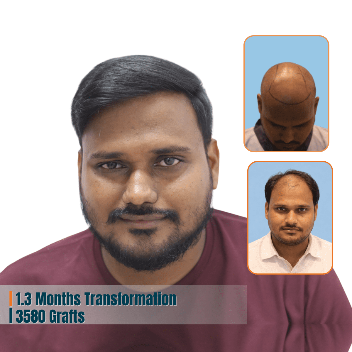 Best Hair Transplant Doctor in Bhubaneswar | Advanced Hair Restoration Clinic | Alloroots 11 Alloroots Hair Transplant Clinic - India's Best Hair Transplant Services