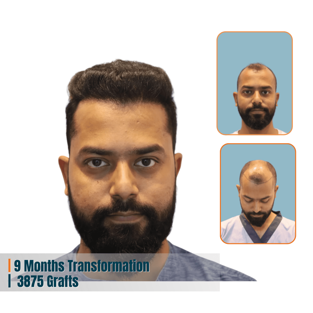 Best Hair Transplant Doctor in Bhubaneswar | Advanced Hair Restoration Clinic | Alloroots 8 Alloroots Hair Transplant Clinic - India's Best Hair Transplant Services