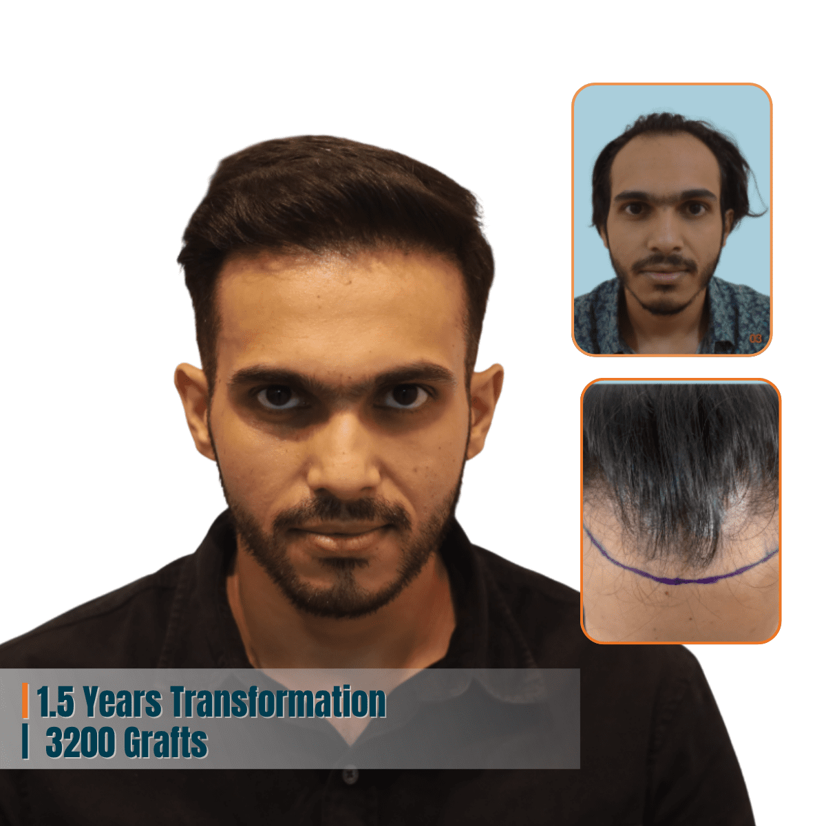 Best Hair Transplant Doctor in Bhubaneswar | Advanced Hair Restoration Clinic | Alloroots 9 Alloroots Hair Transplant Clinic - India's Best Hair Transplant Services