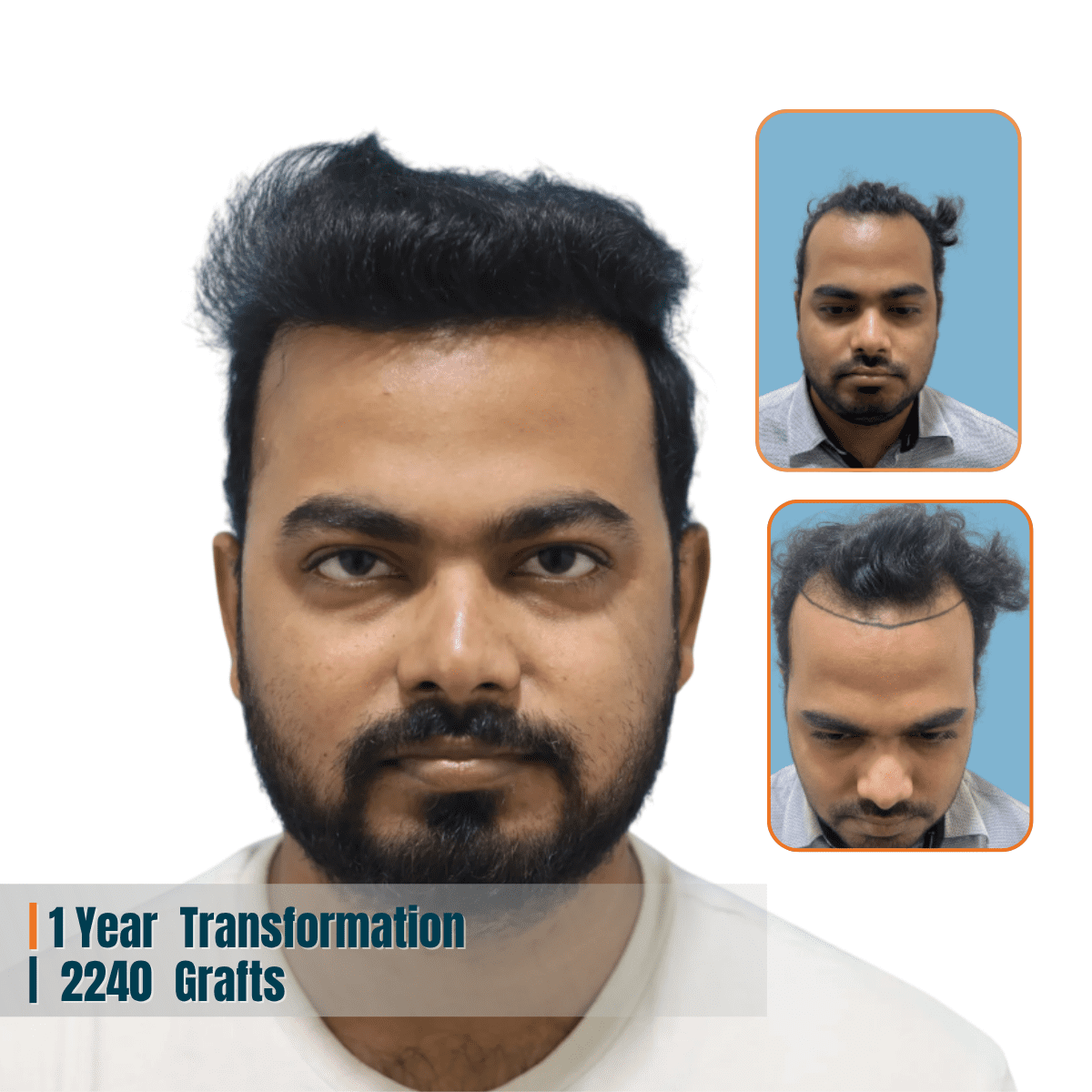 Best Hair Transplant Doctor in Bhubaneswar | Advanced Hair Restoration Clinic | Alloroots 10 Alloroots Hair Transplant Clinic - India's Best Hair Transplant Services