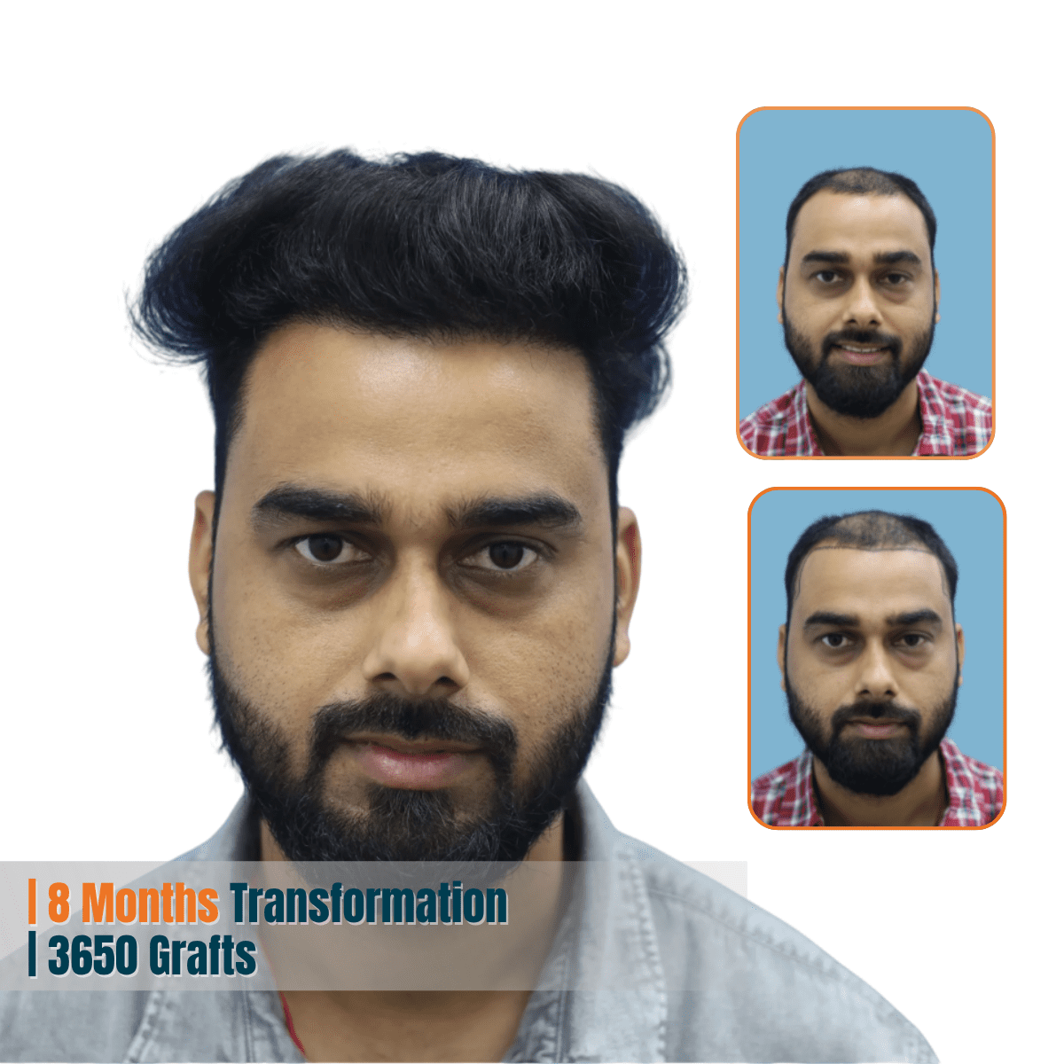 Best Hair Transplant Doctor in Bhubaneswar | Advanced Hair Restoration Clinic | Alloroots 12 Alloroots Hair Transplant Clinic - India's Best Hair Transplant Services