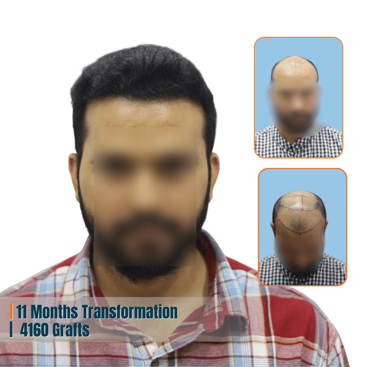 Best Hair Transplant Doctor in Bhubaneswar | Advanced Hair Restoration Clinic | Alloroots 7 Alloroots Hair Transplant Clinic - India's Best Hair Transplant Services