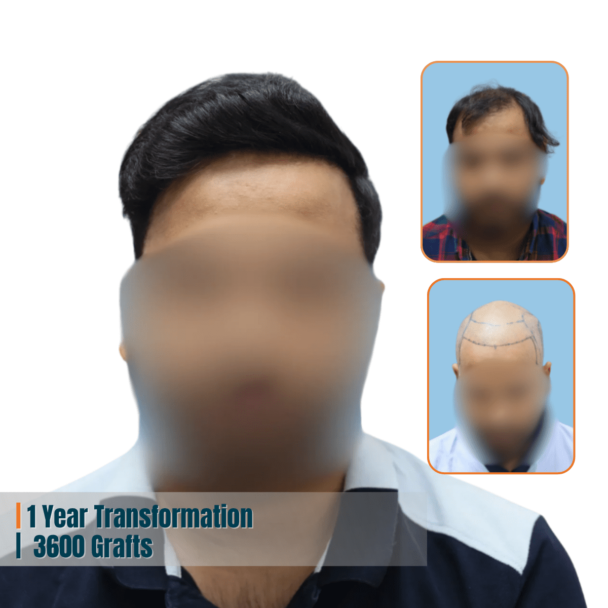 Best Hair Transplant Doctor in Bhubaneswar | Advanced Hair Restoration Clinic | Alloroots 13 Alloroots Hair Transplant Clinic - India's Best Hair Transplant Services
