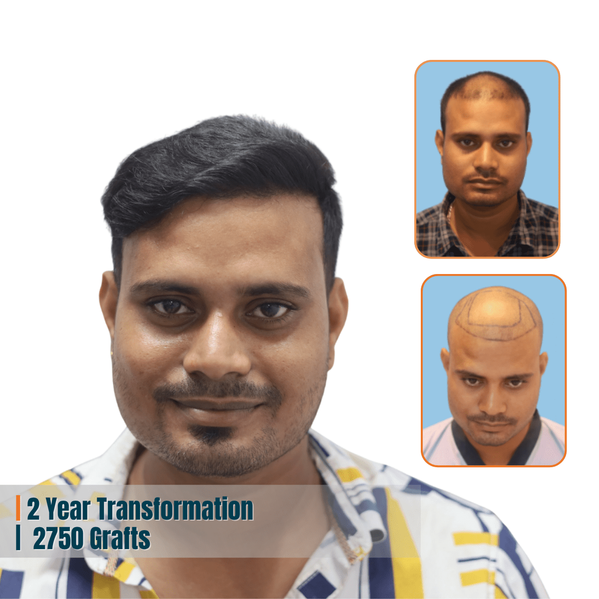 Best Hair Transplant Doctor in Bhubaneswar | Advanced Hair Restoration Clinic | Alloroots 14 Alloroots Hair Transplant Clinic - India's Best Hair Transplant Services
