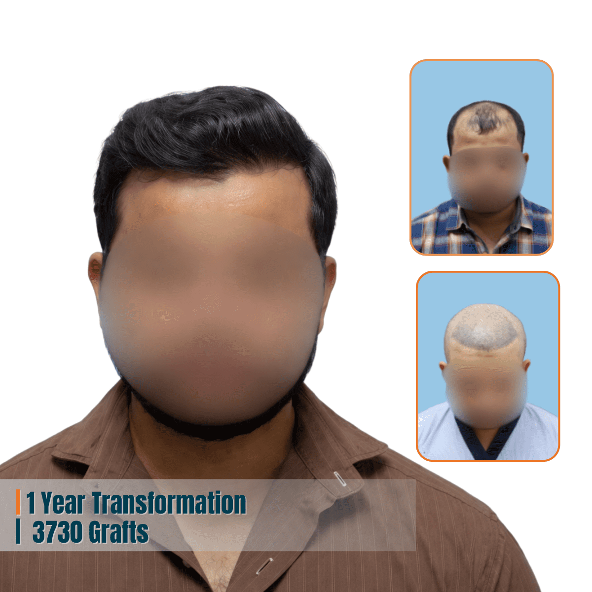 Best Hair Transplant Doctor in Bhubaneswar | Advanced Hair Restoration Clinic | Alloroots 15 Alloroots Hair Transplant Clinic - India's Best Hair Transplant Services