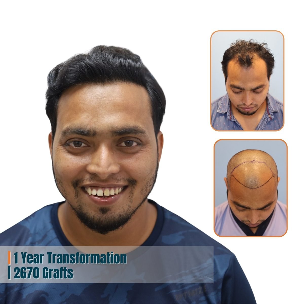 Best Hair Transplant Doctor in Bhubaneswar | Advanced Hair Restoration Clinic | Alloroots 6 Alloroots Hair Transplant Clinic - India's Best Hair Transplant Services