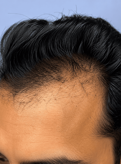 Best Hair Transplant Doctor in Bhubaneswar | Advanced Hair Restoration Clinic | Alloroots - Alloroots Hair Transplant Clinic - India's Best Hair Transplant Services