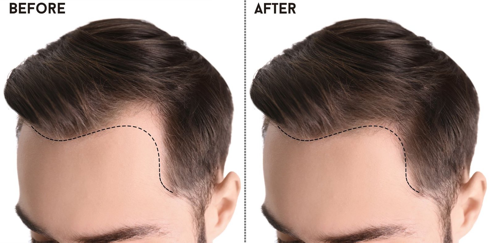 10 Best Hairline Reconstruction for hairline lowering surgery India (2026) - Alloroots Hair Transplant Clinic - India's Best Hair Transplant Services