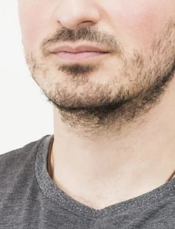 Best Hair Transplant Doctor in Bhubaneswar | Advanced Hair Restoration Clinic | Alloroots - Alloroots Hair Transplant Clinic - India's Best Hair Transplant Services