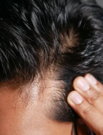 Best Hair Transplant Doctor in Bhubaneswar | Advanced Hair Restoration Clinic | Alloroots - Alloroots Hair Transplant Clinic - India's Best Hair Transplant Services