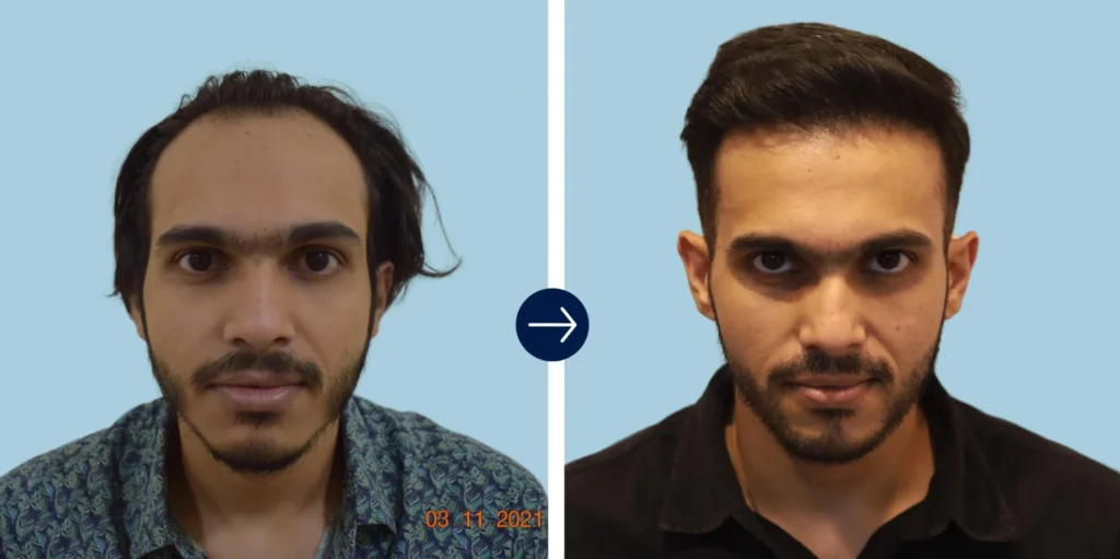 Is Hair Transplant Permanent? Long-Term Hair Growth Results at AlloRoots - Alloroots Hair Transplant Clinic - India's Best Hair Transplant Services