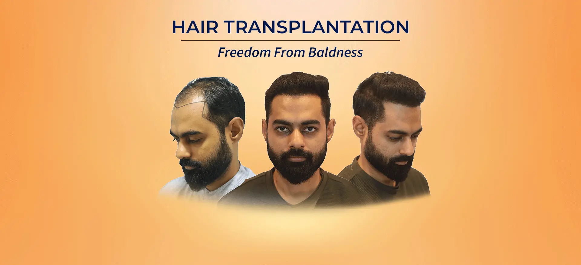 10 Best FUE Hair Transplant – Core Informational for FUE hair transplant India (2026) - Alloroots Hair Transplant Clinic - India's Best Hair Transplant Services