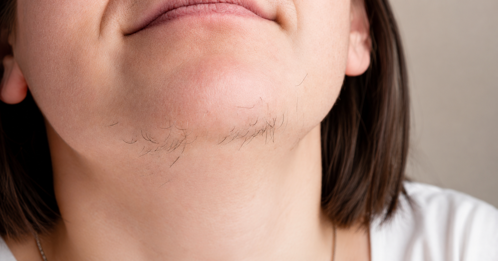 Hirsutism Treatment