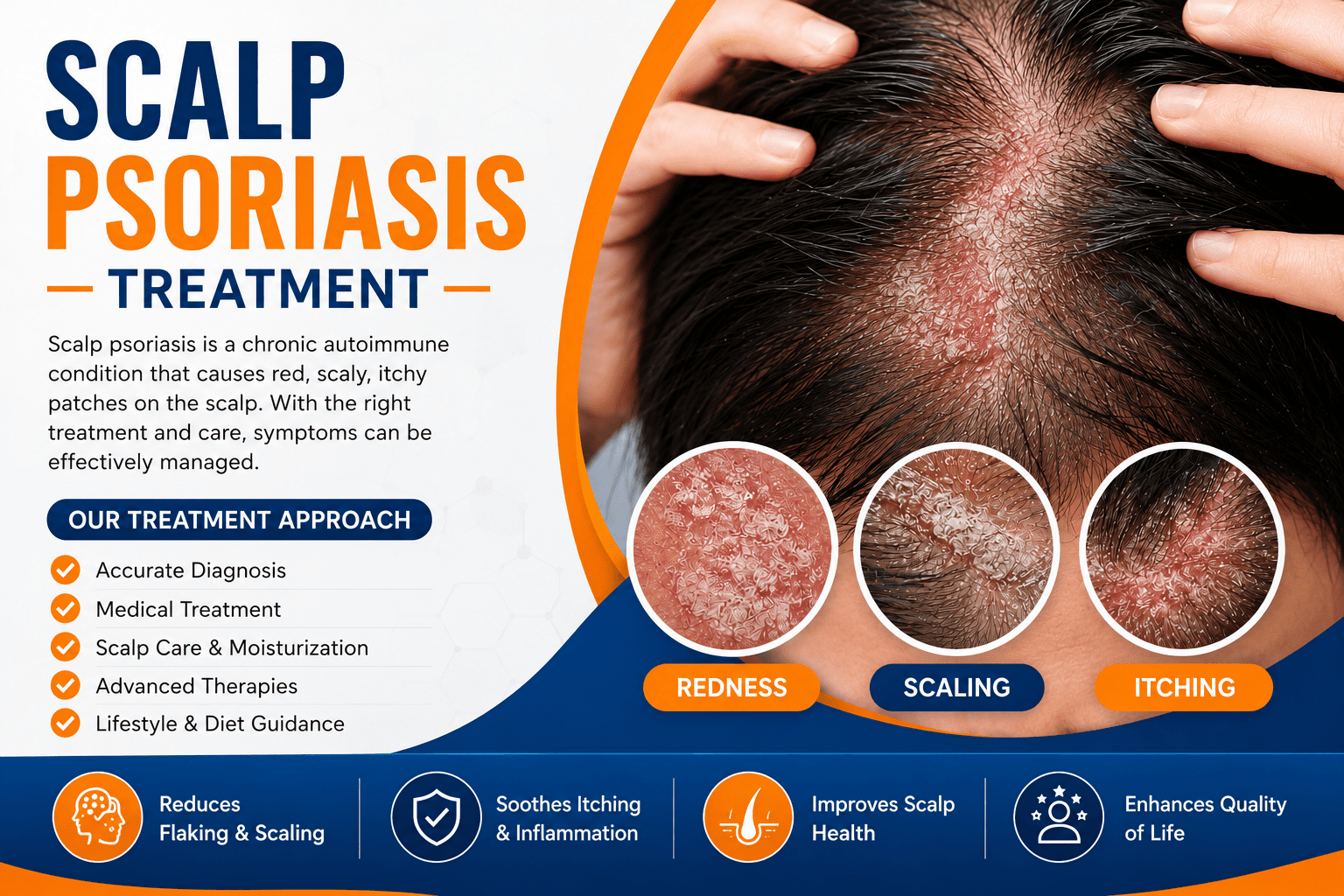 Scalp Psoriasis Treatment