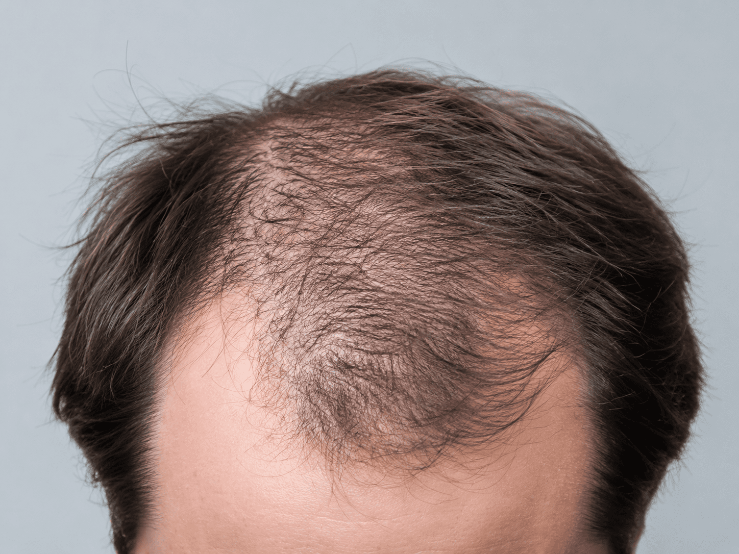 Telogen Effluvium Treatment