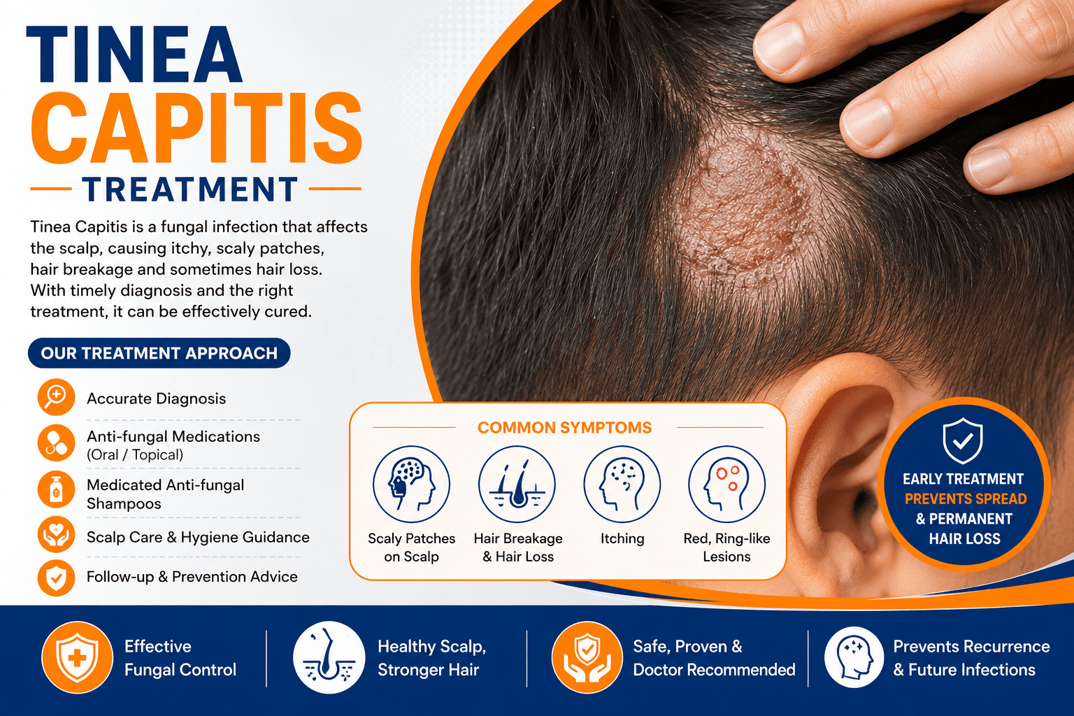 Tinea Capitis Treatment