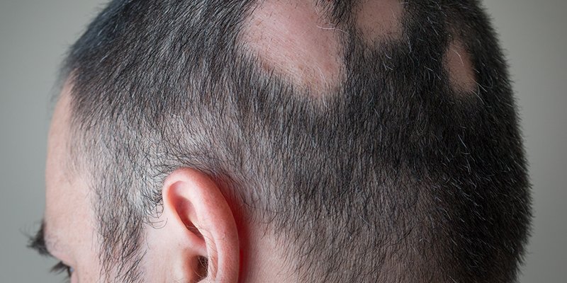 Traction Alopecia Treatment