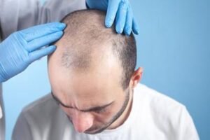 Which Doctor to Consult for Hair Loss in 2026? - Alloroots Hair Transplant Clinic - India's Best Hair Transplant Services