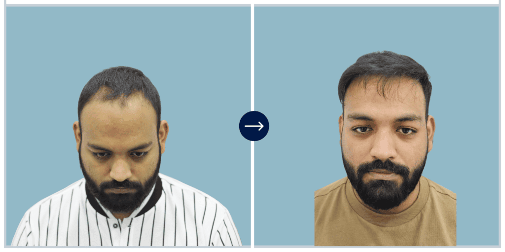 Alloroots Hair Transplant Clinic - India's Best Hair Transplant Services