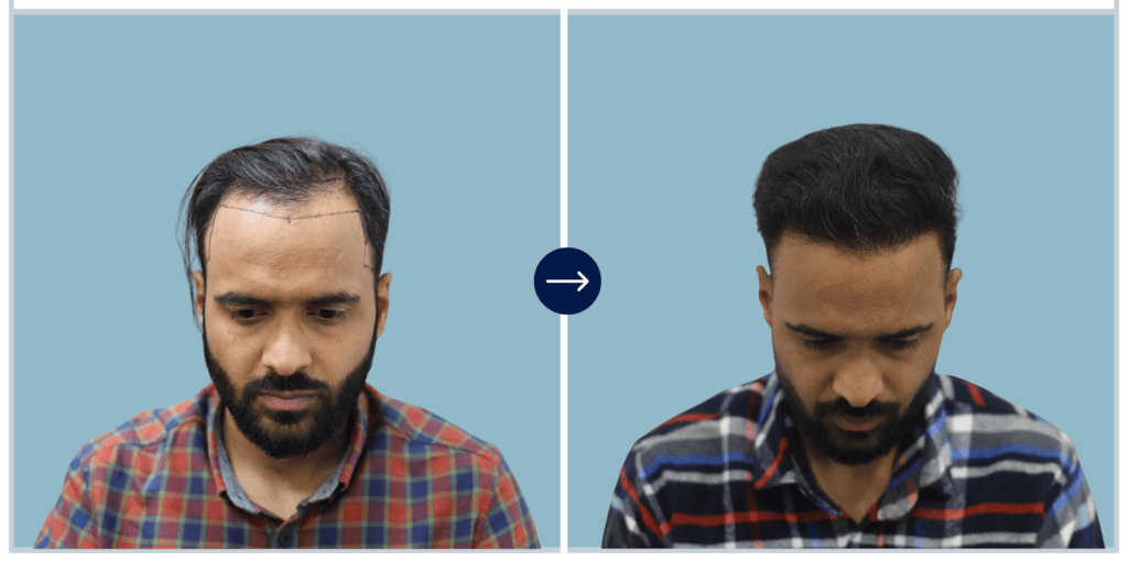 Results - Alloroots Hair Transplant Clinic - India's Best Hair Transplant Services