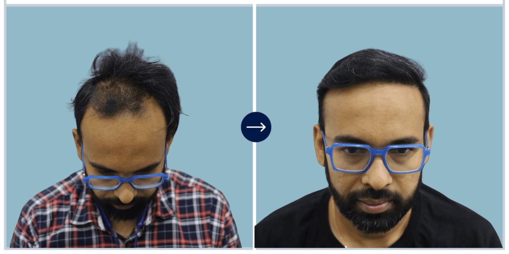 Alloroots Hair Transplant Clinic - India's Best Hair Transplant Services
