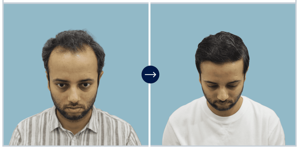 Alloroots Hair Transplant Clinic - India's Best Hair Transplant Services