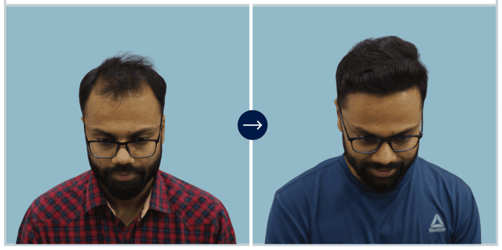 Alloroots Hair Transplant Clinic - India's Best Hair Transplant Services