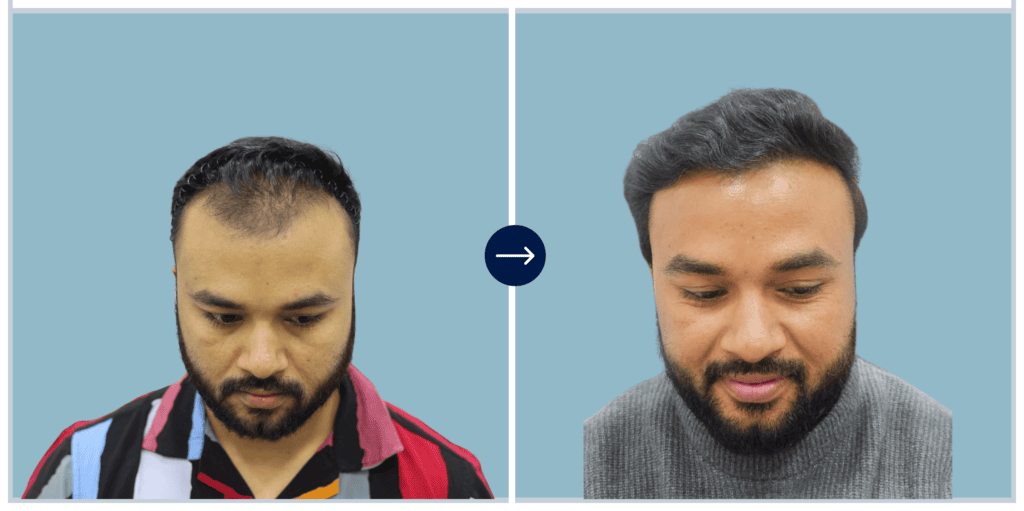 Alloroots Hair Transplant Clinic - India's Best Hair Transplant Services