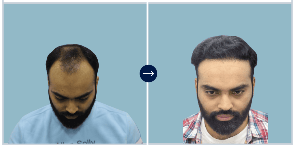Alloroots Hair Transplant Clinic - India's Best Hair Transplant Services