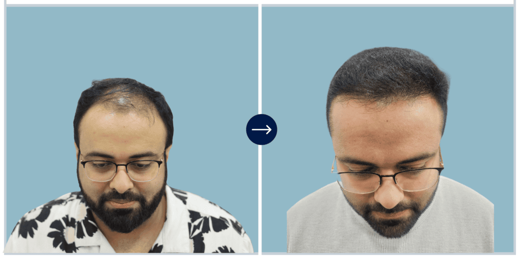 Alloroots Hair Transplant Clinic - India's Best Hair Transplant Services
