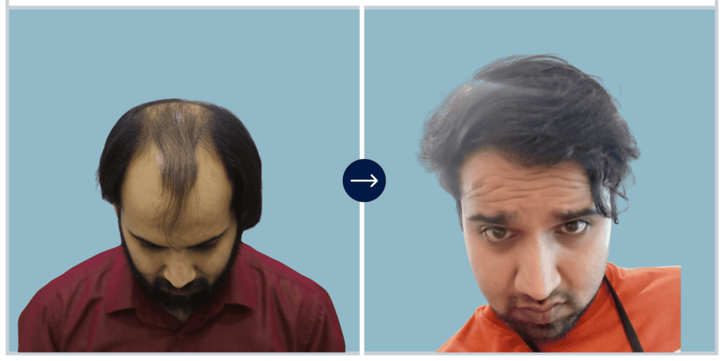 Alloroots Hair Transplant Clinic - India's Best Hair Transplant Services