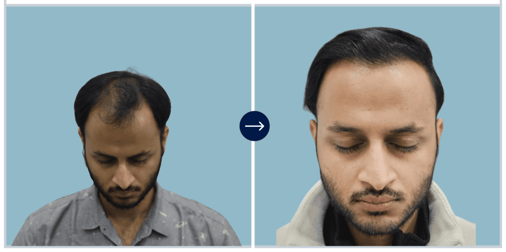 Alloroots Hair Transplant Clinic - India's Best Hair Transplant Services