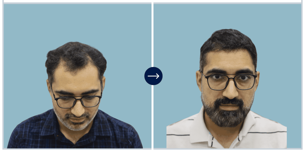 Alloroots Hair Transplant Clinic - India's Best Hair Transplant Services