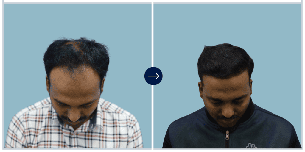 Alloroots Hair Transplant Clinic - India's Best Hair Transplant Services