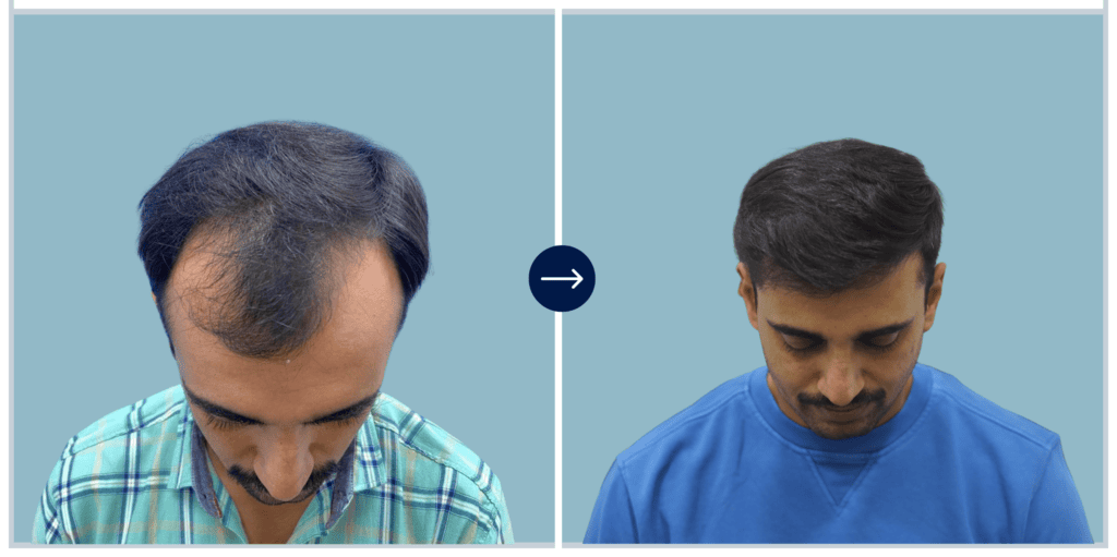 Alloroots Hair Transplant Clinic - India's Best Hair Transplant Services