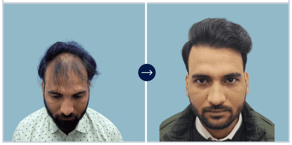 Alloroots Hair Transplant Clinic - India's Best Hair Transplant Services